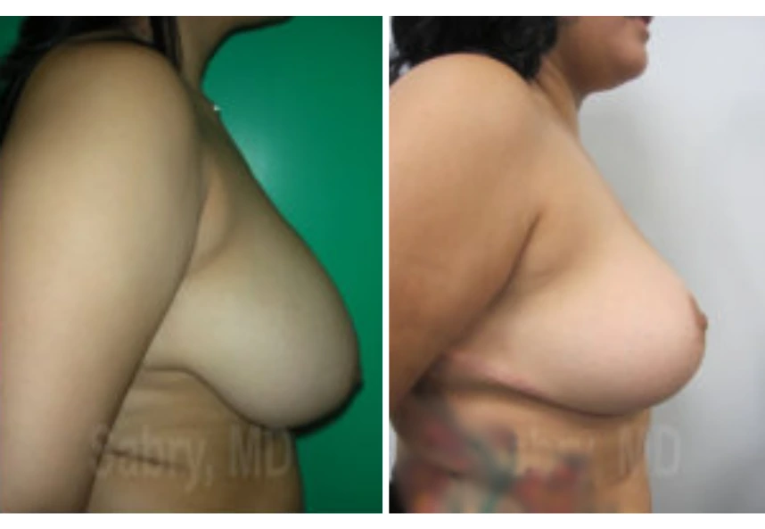 Breast Reduction - Case 16 b