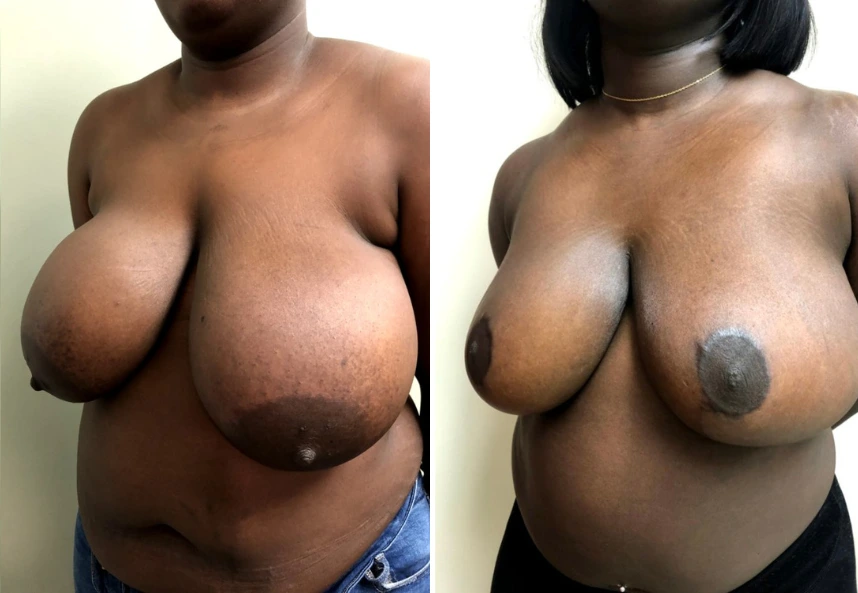 Breast Reduction – Case 10 a