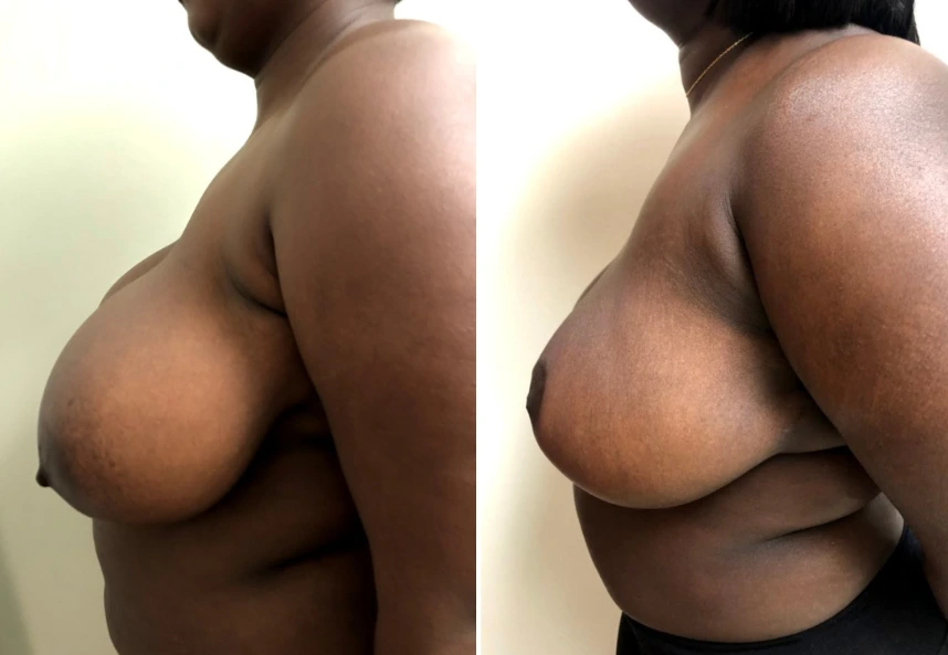 Breast Reduction – Case 10 b