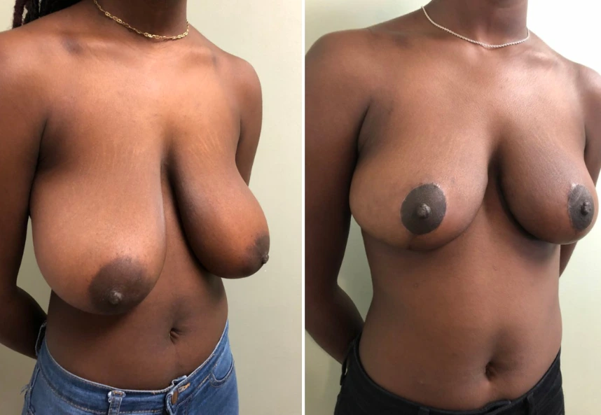 Breast Reduction – Case 11 a