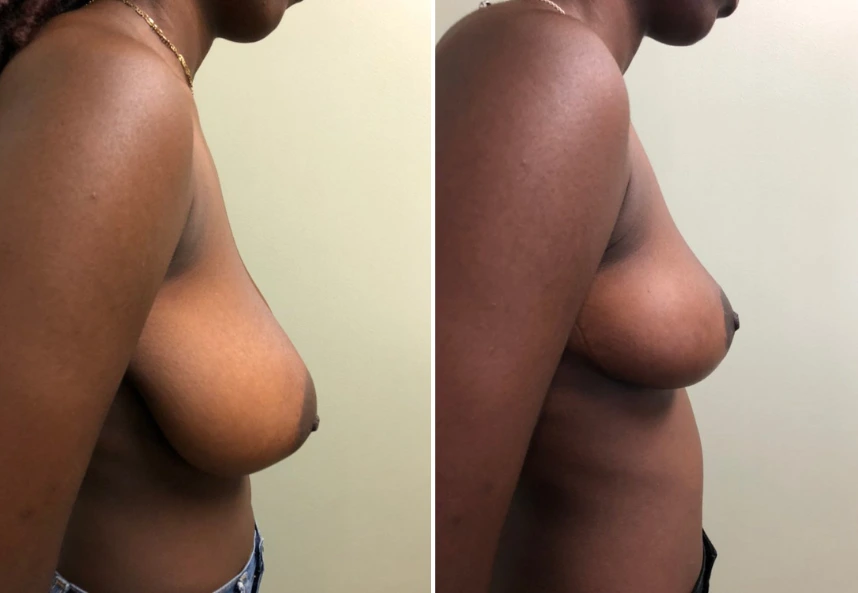 Breast Reduction – Case 11 b