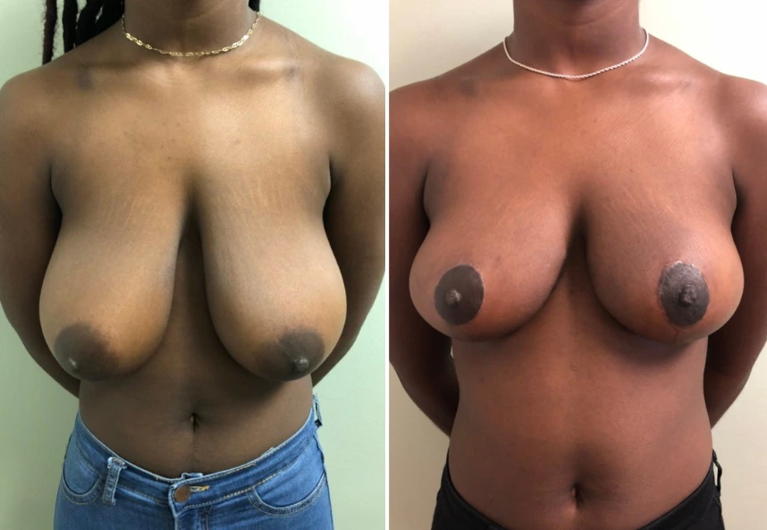 Breast Reduction – Case 11