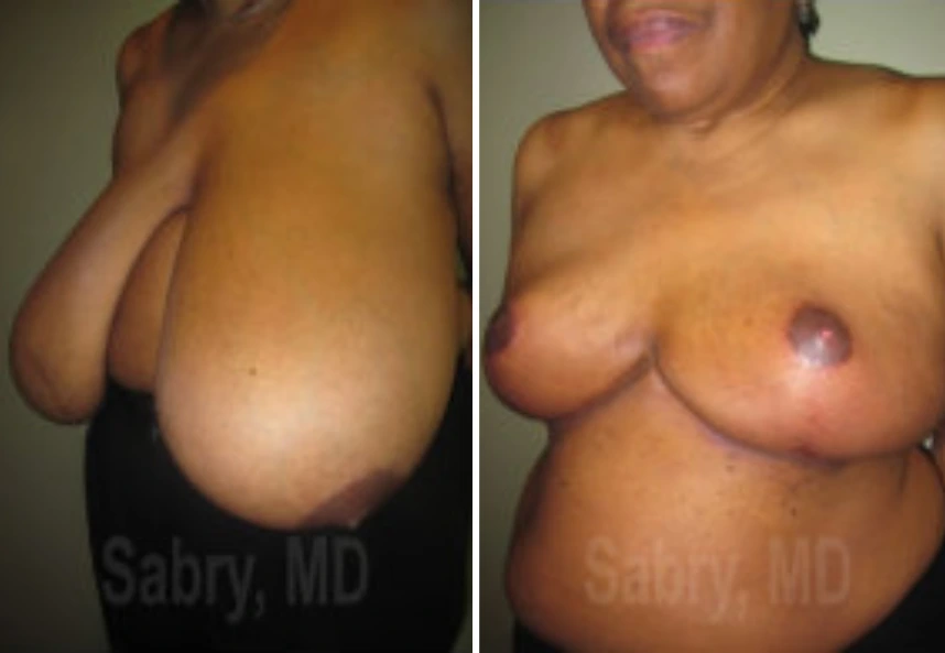 Breast Reduction – Case 14 a