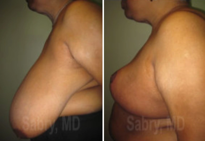 Breast Reduction – Case 14 b