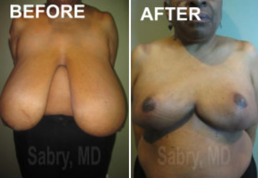 Breast Reduction – Case 14