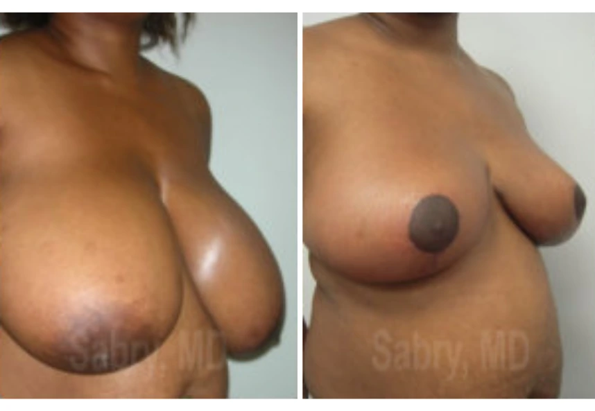 Breast Reduction – Case 15 a