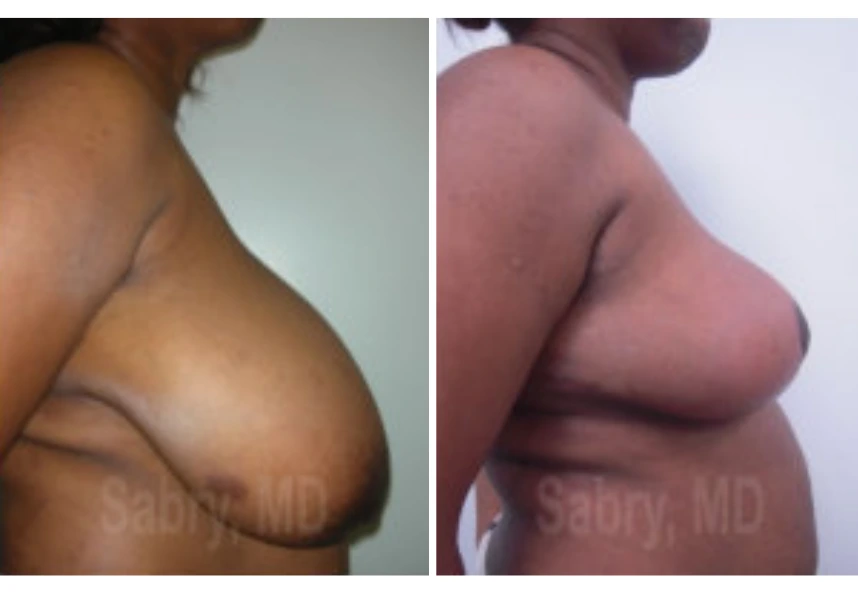 Breast Reduction – Case 15 b