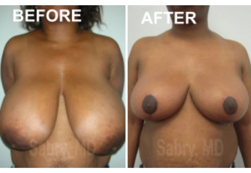 Breast Reduction – Case 15
