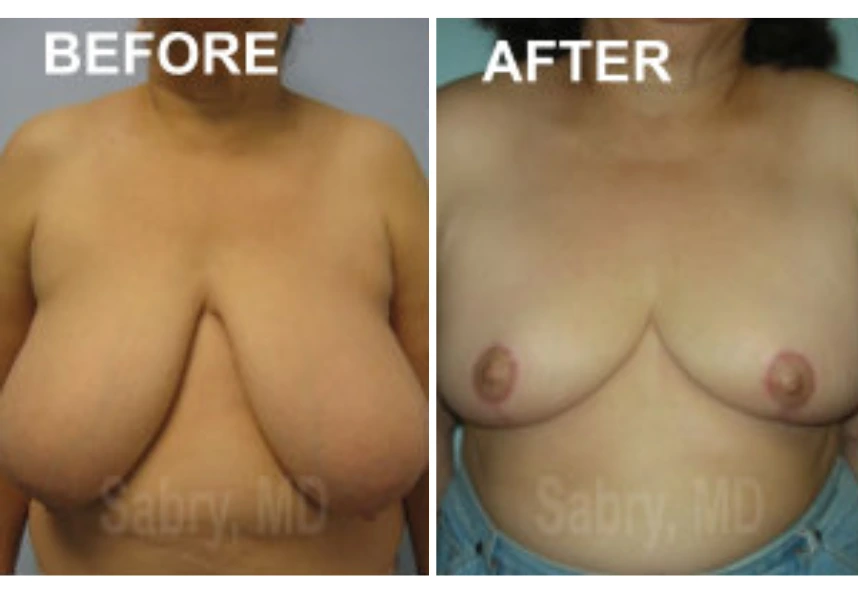Breast Reduction – Case 17