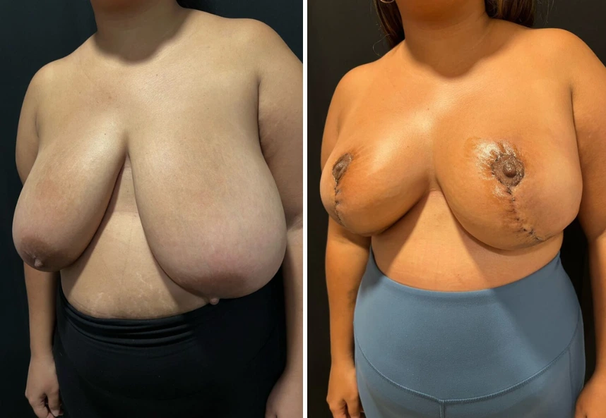 Breast Reduction – Case 2 a