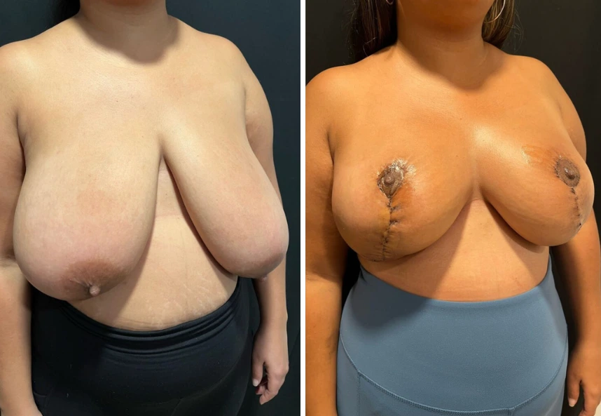Breast Reduction – Case 2 b