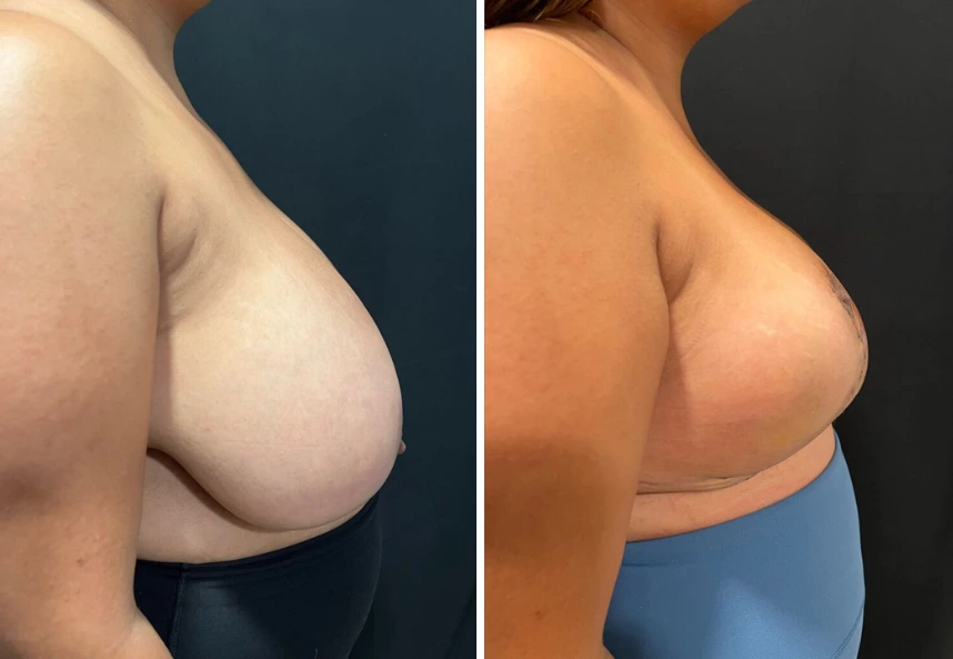 Breast Reduction – Case 2 d