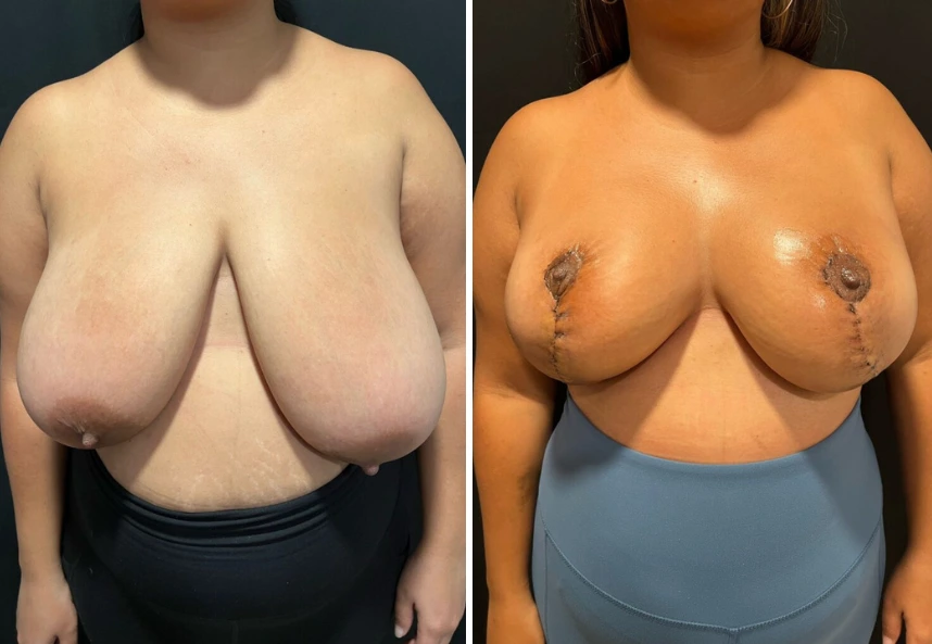 Breast Reduction – Case 2