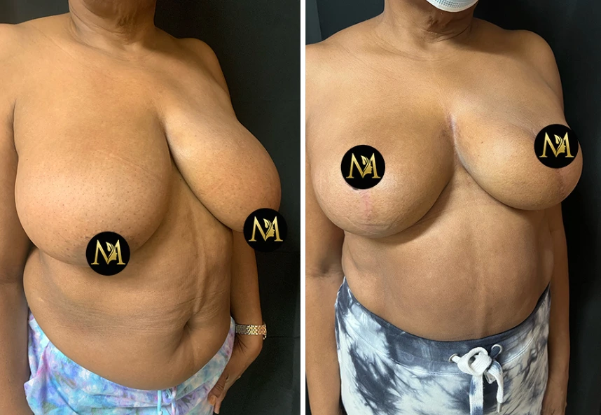 Breast Reduction – Case 4 a