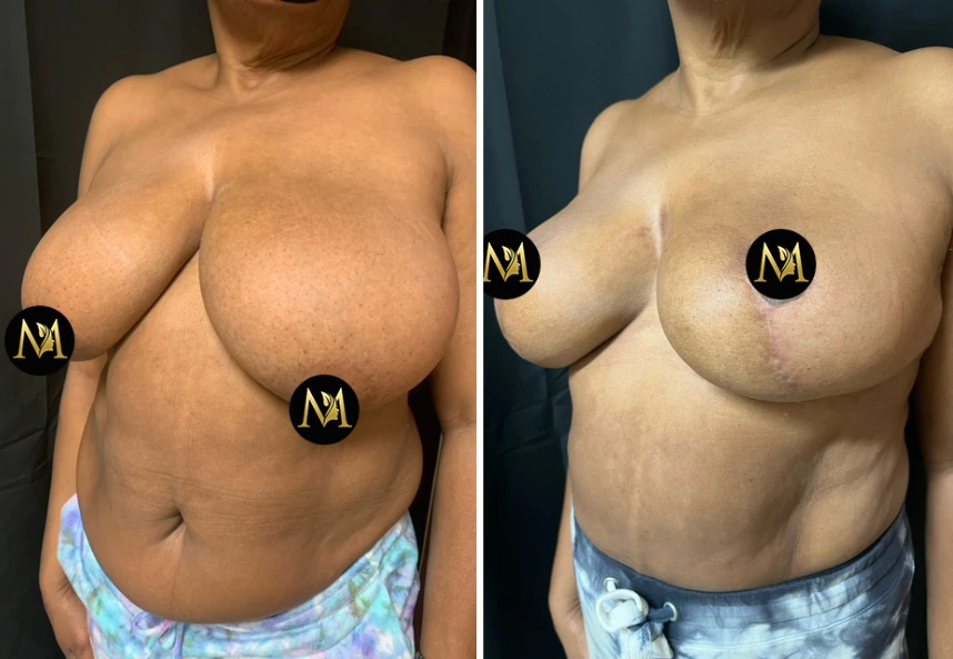 Breast Reduction – Case 4 b