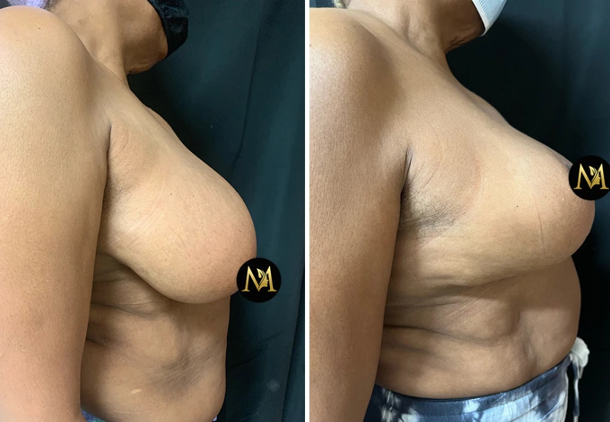 Breast Reduction – Case 4 c