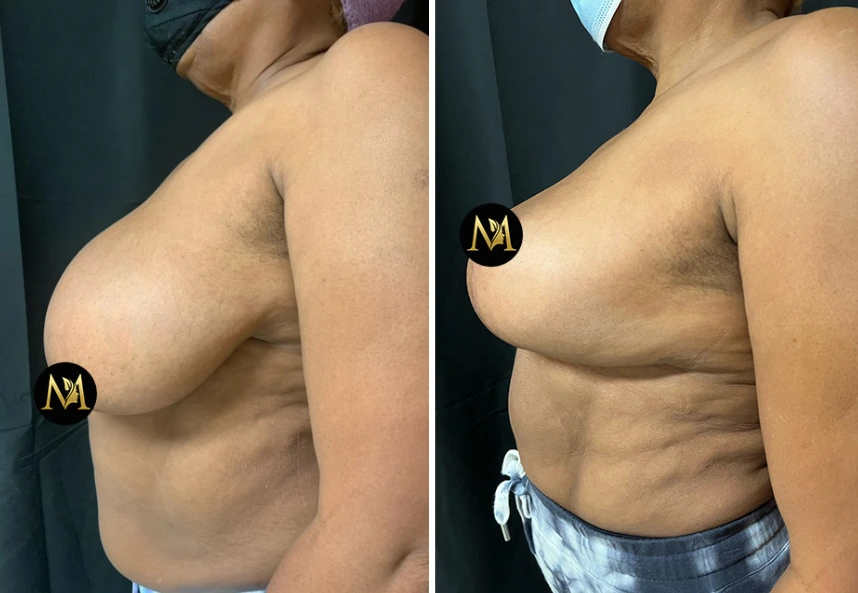 Breast Reduction – Case 4 d