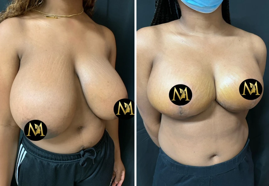 Breast Reduction – Case 5 a