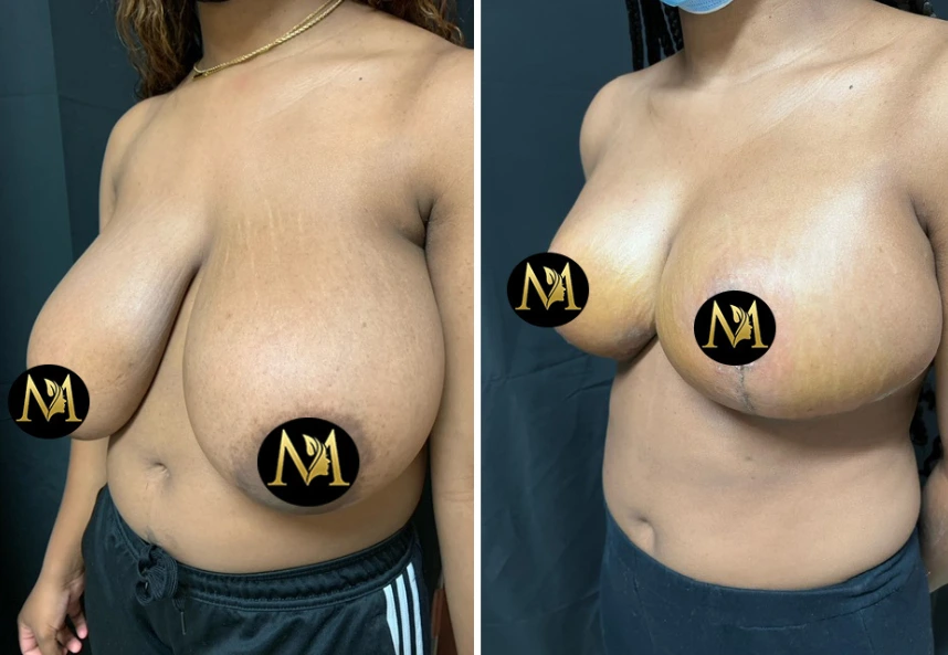 Breast Reduction – Case 5 b