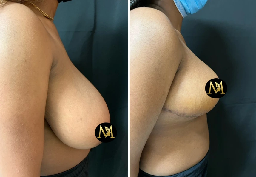 Breast Reduction – Case 5 c