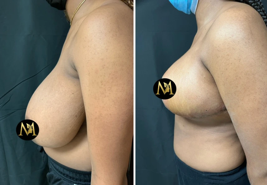 Breast Reduction – Case 5 d