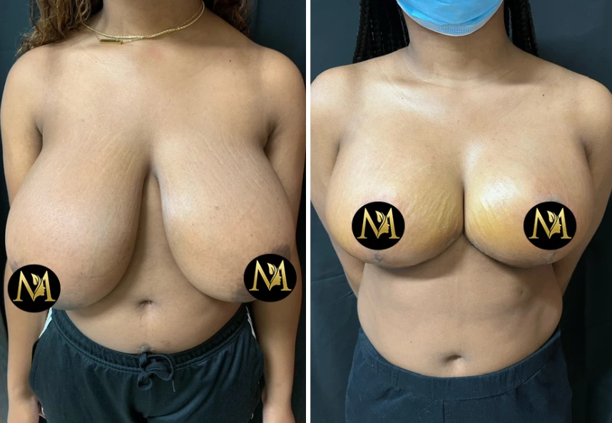 Breast Reduction – Case 5