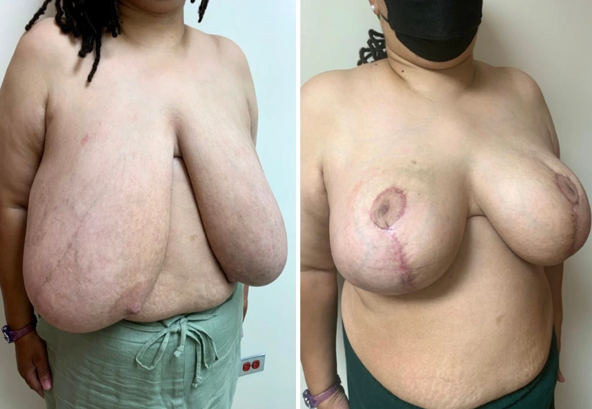 Breast Reduction – Case 8 a