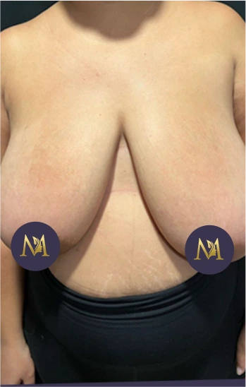 Breast Reduction Before & After