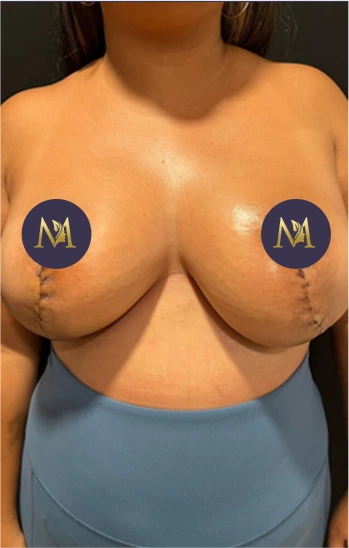 Breast Reduction Before & After