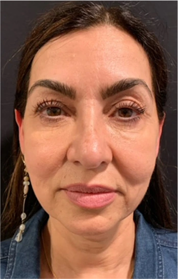 Facelift Before & After Banner