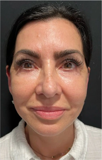 Facelift Before & After Banner