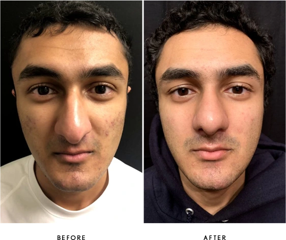 Rhinoplasty Before & After