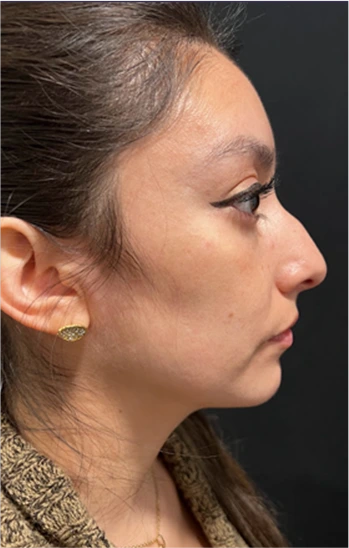 Rhinoplasty Before & After Banner