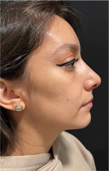 Rhinoplasty Before & After Banner