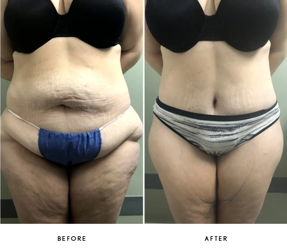 Tummy Tuck Before & After Banner