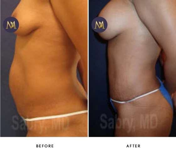 Tummy Tuck Before & After