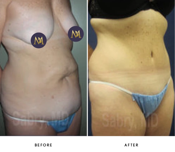 Tummy Tuck Before & After