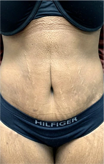 Tummy Tuck Before & After