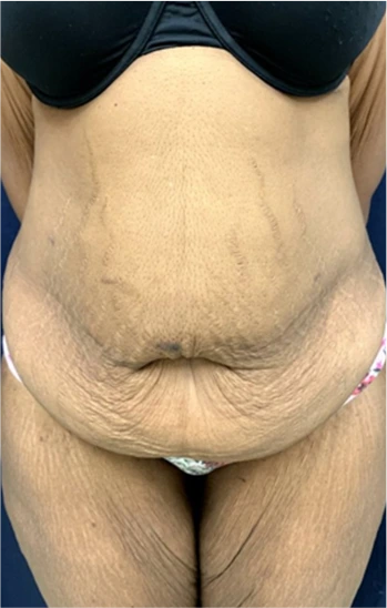 Tummy Tuck Before & After