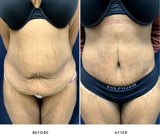 Tummy Tuck Before & After Banner