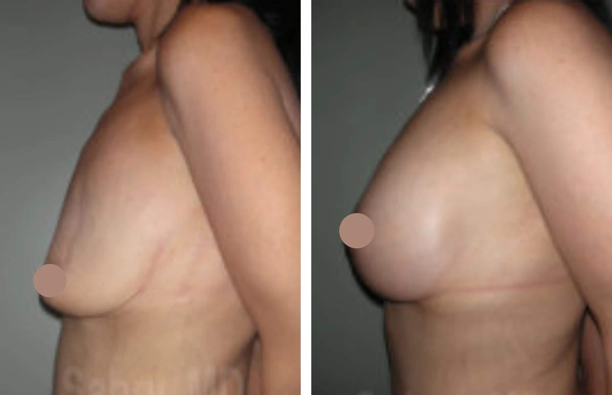 Breast Lift Before & After in NYC Banner