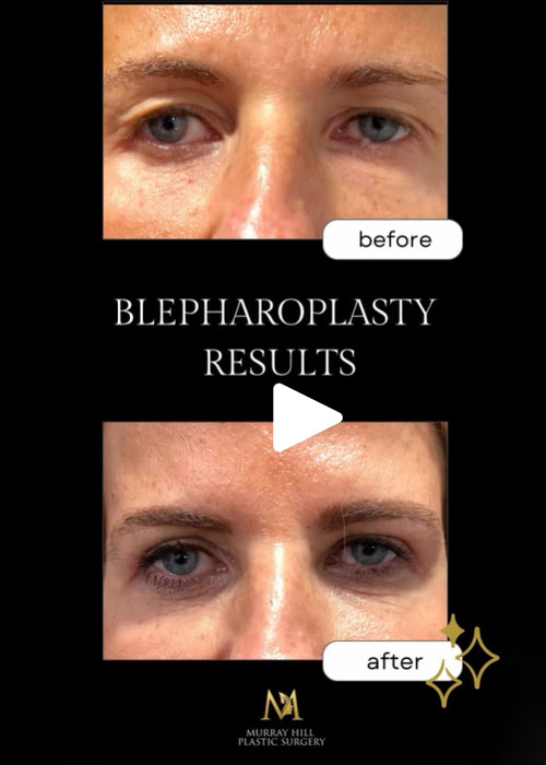 before and after blepharoplasty results Murray Hill Plastic Surgery