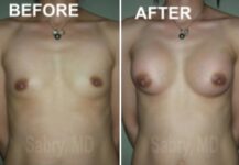 before and after breast augmentation Dr. Sabry front view female patient case 28643