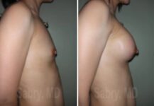 before and after breast augmentation Dr. Sabry side view female patient case 28643