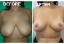 before and after breast lift front view case 28823