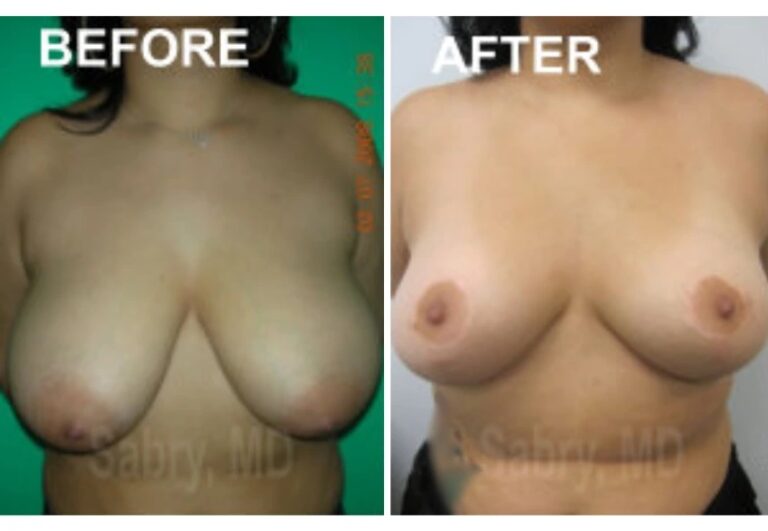 before and after breast lift front view case 28823