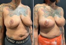 before and after breast reconstruction NYC right angle view female patient case 28651