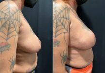 before and after breast reconstruction NYC right side view female patient case 28651