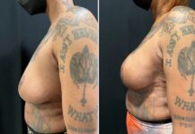 before and after breast reconstruction NYC left side view female patient case 28651