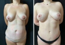 before and after breast reduction front view female patient case 28679